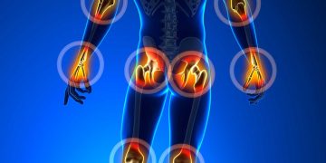 التهاب المفاصل