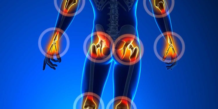 التهاب المفاصل