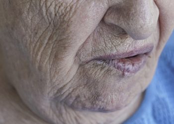 ساعدني العلاج في مشكلة شلل  الوجه