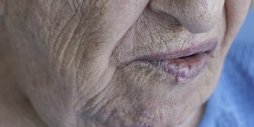 ساعدني العلاج في مشكلة شلل  الوجه