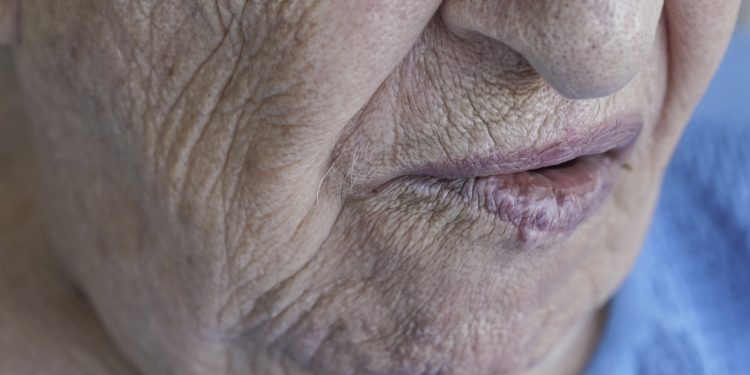 ساعدني العلاج في مشكلة شلل الوجه