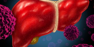 سرطان الكبد