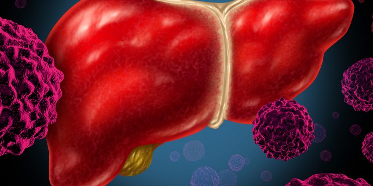 سرطان الكبد