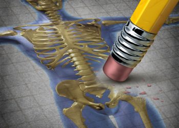 هشاشة العظام