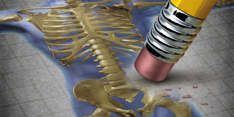 هشاشة العظام