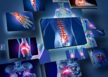 التهاب المفاصل