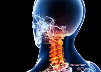 تصلب الرقبة