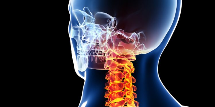 تصلب الرقبة