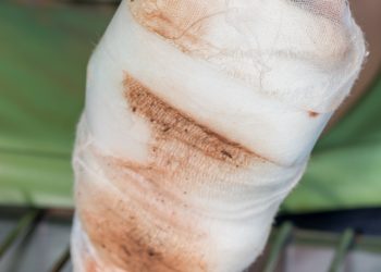 مشاكل في النخر ومشاكل في الاوعية الدموية….طريقة علاج يستحسن التعرف عليه