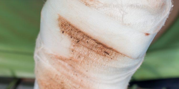 مشاكل في النخر ومشاكل في الاوعية الدموية….طريقة علاج يستحسن التعرف عليه