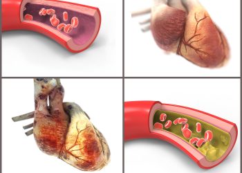 مشاكل في النخر ومشاكل في الاوعية الدموية….طريقة علاج يستحسن التعرف عليه
