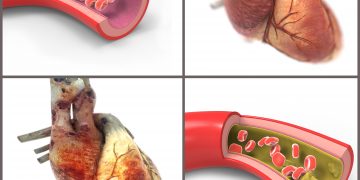 مشاكل في النخر ومشاكل في الاوعية الدموية….طريقة علاج يستحسن التعرف عليه