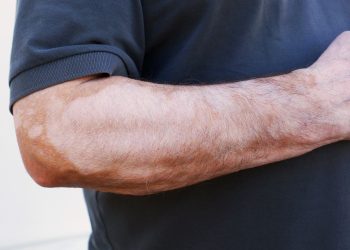 لقد نجحت طريقة علاج أورن زريف في مساعدة العديد من المرضى الذين عانوا من امراض جلدية عصيبة[يعالج جميع أنواع الأمراض الجلدية دون استثناء]