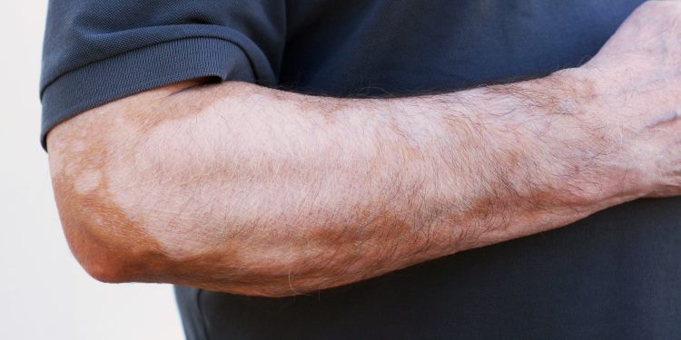 لقد نجحت طريقة علاج أورن زريف في مساعدة العديد من المرضى الذين عانوا من امراض جلدية عصيبة[يعالج جميع أنواع الأمراض الجلدية دون استثناء]