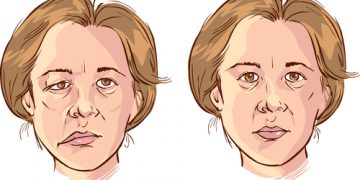 تعانون من الشلل في الوجه؟  لاداعي لليأس.