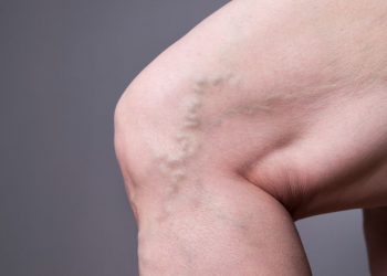 "تمزق الوتر يلتئم بدون جراحة!" –  أورن زريف  – Oren Zarif