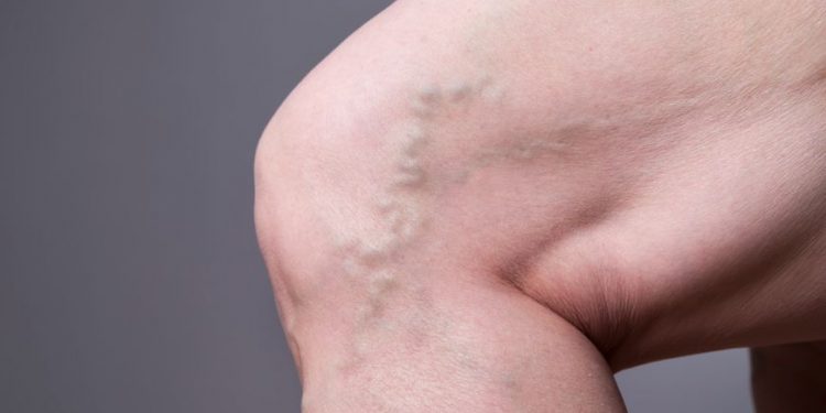 "تمزق الوتر يلتئم بدون جراحة!" –  أورن زريف  – Oren Zarif