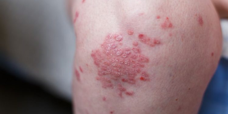 "شكرا لأورن ظريف ، لقد تغلبت على الصدفية!" –  أورن زريف  – Oren Zarif