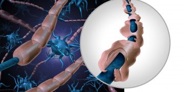 كرامر: "عالج أورن ظريف ابنتي التي تعاني من مرض التصلب العصبي المتعدد (MS) وساعدها بشكل كبير."