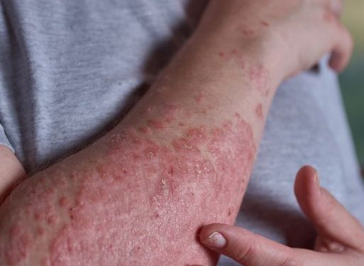 "بفضل أورن ظريف تخلصت من الصدفية!" –  أورن زريف  – Oren Zarif