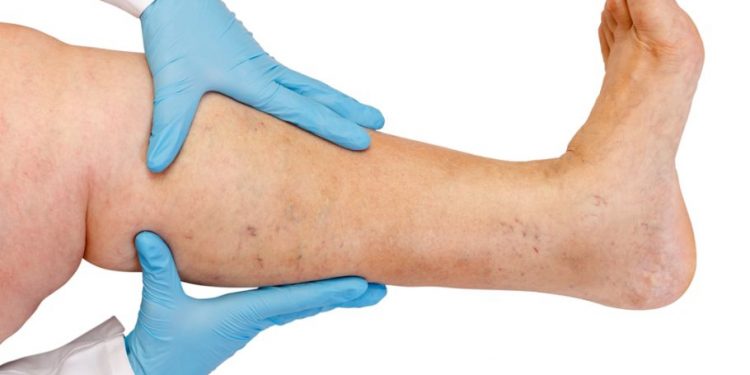 "أورن ظريف أنقذ رجلي من البتر" –  أورن زريف  – Oren Zarif