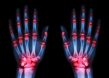 "أورن ظريف يزيل الألم – تم إلغاء جراحة اليد!" –  أورن زريف  – Oren Zarif