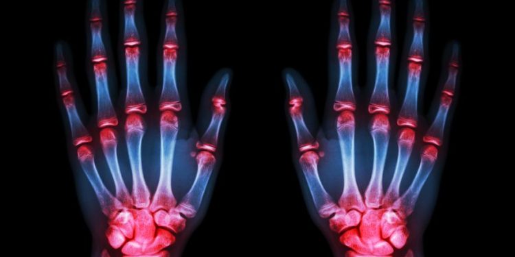 "أورن ظريف يزيل الألم – تم إلغاء جراحة اليد!" –  أورن زريف  – Oren Zarif